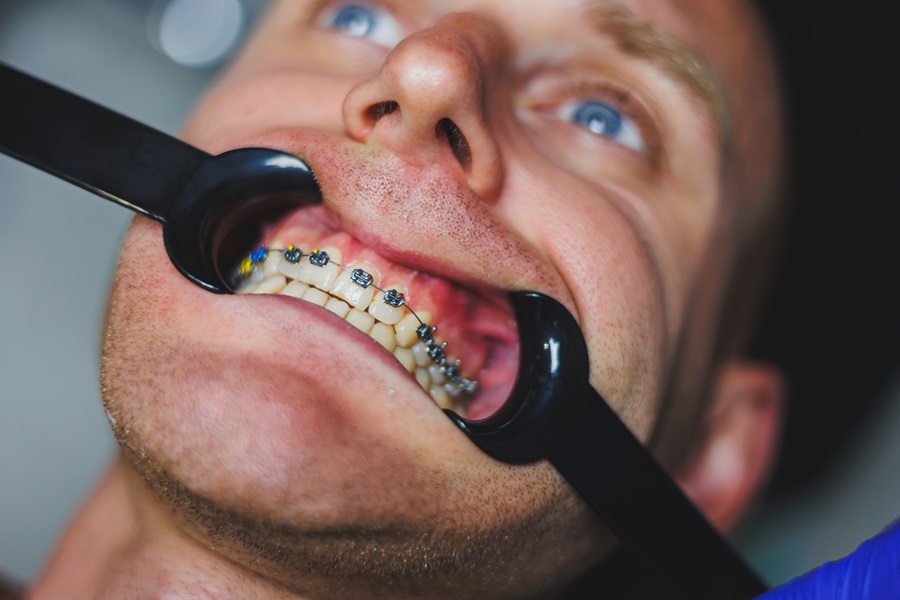 Do I really need to wear my rubber bands with my braces?