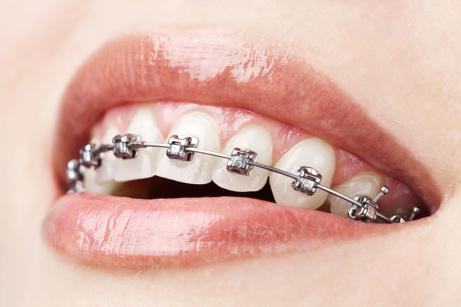 Achieving a Straighter Smile with Metal Braces in Southaven, MS: What You Need to Know