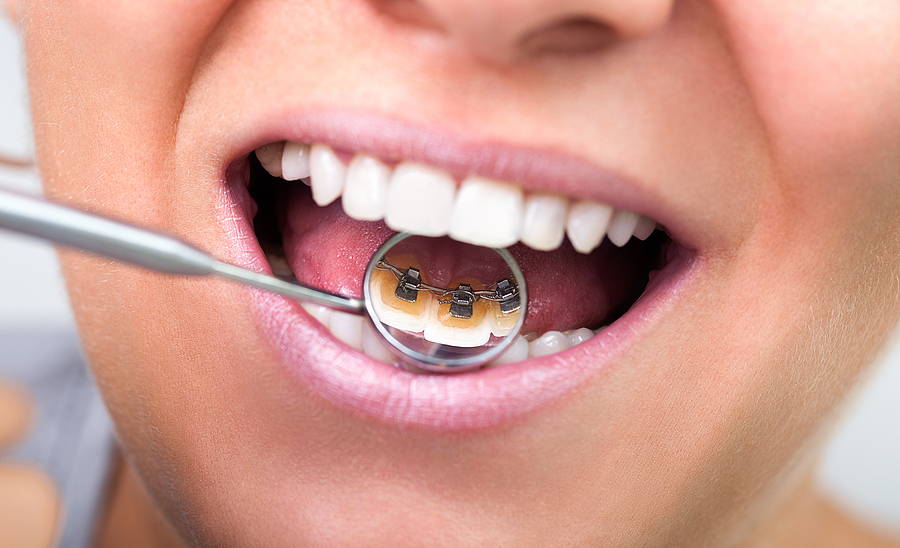 Health Benefits of Straight Teeth: How Orthodontics Improves Overall Well-being